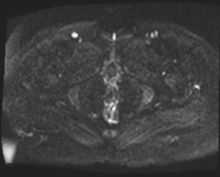 Cancer cervix - stage IIb (Radiopaedia 75411-86615 Axial DWI 32).jpg