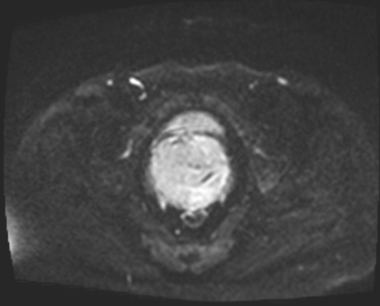 Cancer cervix - stage IIb (Radiopaedia 75411-86615 Axial DWI 42).jpg