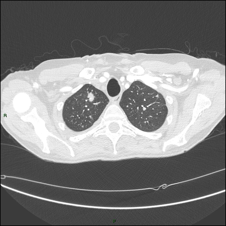 Cannonball metastases (Radiopaedia 82110-96150 Axial lung window 38).jpg