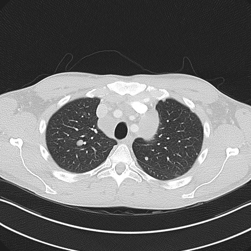 Cannonball metastases - testicular choriocarcinoma (Radiopaedia 84510-99891 Axial lung window 26).jpg