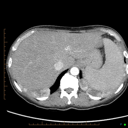 Canonball lung metastasis (Radiopaedia 77634-89837 B 94).jpg