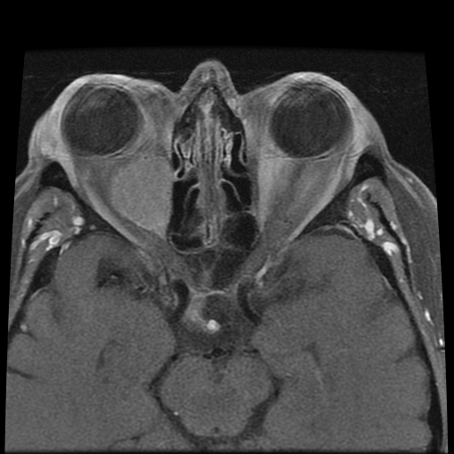 File:Carcinoid tumor of the ileum with metastasis to orbit (Radiopaedia 28165-28424 Axial T1 C+ fat sat 9).jpg