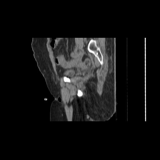 File:Carcinoma cervix- brachytherapy applicator (Radiopaedia 33135-34173 D 52).jpg