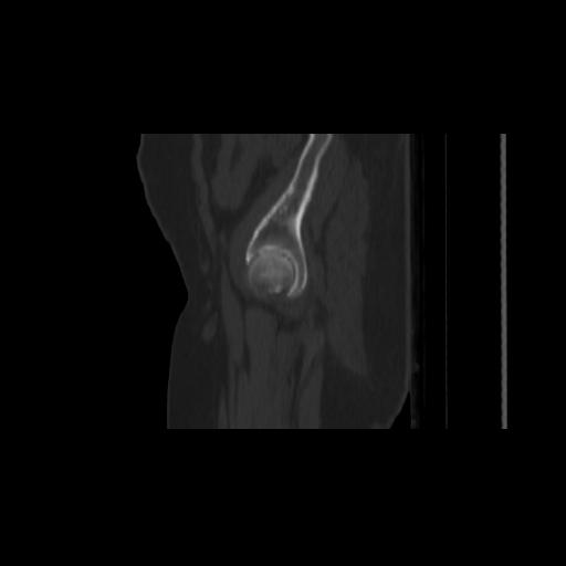 File:Carcinoma cervix- brachytherapy applicator (Radiopaedia 33135-34173 Sagittal bone window 9).jpg