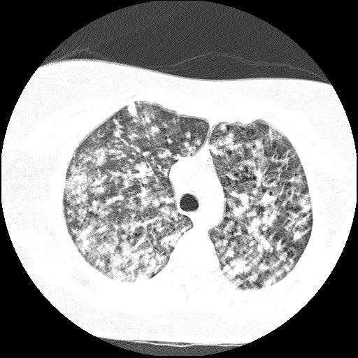 Cardiac angiosarcoma (Radiopaedia 66010-75181 Axial lung window 67).jpg