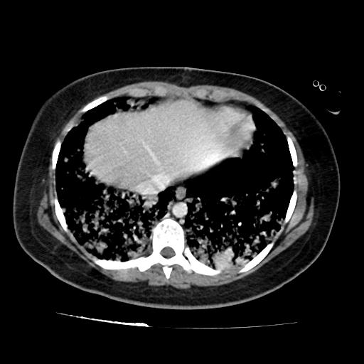 File:Cardiac angiosarcoma (Radiopaedia 66010-75181 B 76).jpg