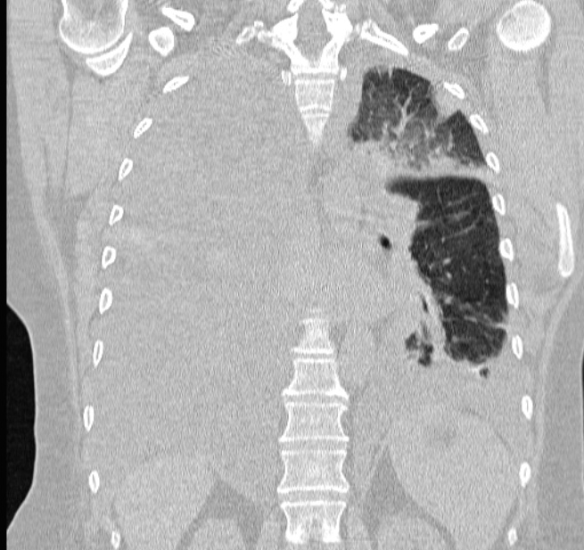 Cardiogenic pulmonary edema (Radiopaedia 29213-29609 Coronal lung window 46).jpg