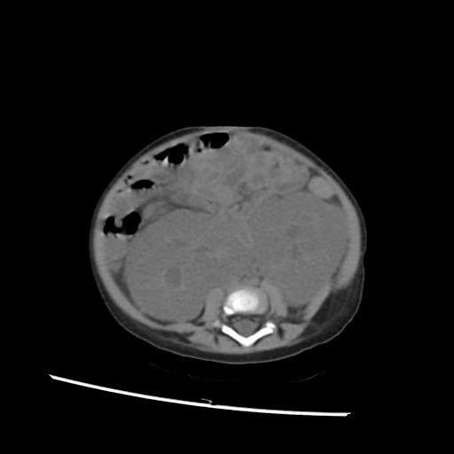File:Caroli disease with autosomal recessive polycystic kidney disease (ARPKD) (Radiopaedia 89651-106703 Axial non-contrast 38).jpg
