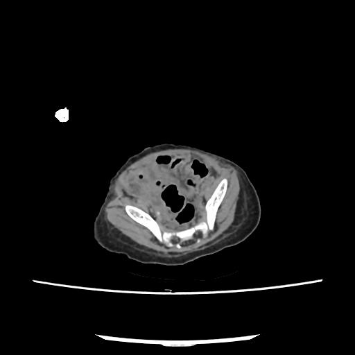 Caroli disease with autosomal recessive polycystic kidney disease (ARPKD) (Radiopaedia 89651-106703 E 199).jpg