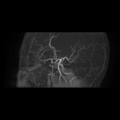 Carotid arterial dissection with acute cerebral infarction (Radiopaedia 26636-26784 MRA 8).jpg
