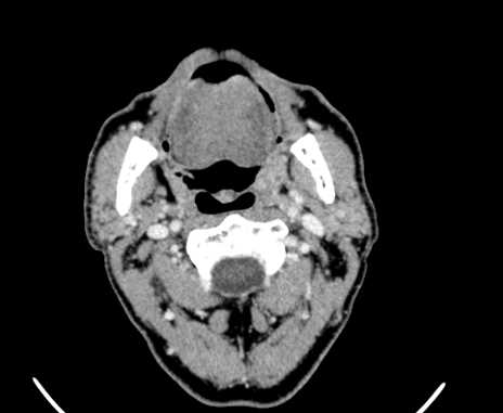 File:Carotid body tumor (Radiopaedia 61750-69757 Axial Post contrast 24).jpg