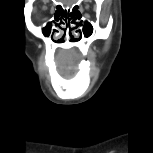 File:Carotid body tumor (paraganglioma) (Radiopaedia 38586-40729 B 8).jpg