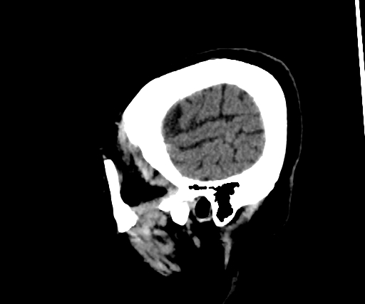 Cavernous hemangioma of the cerebellar falx (Radiopaedia 73025-83723 B 289).jpg