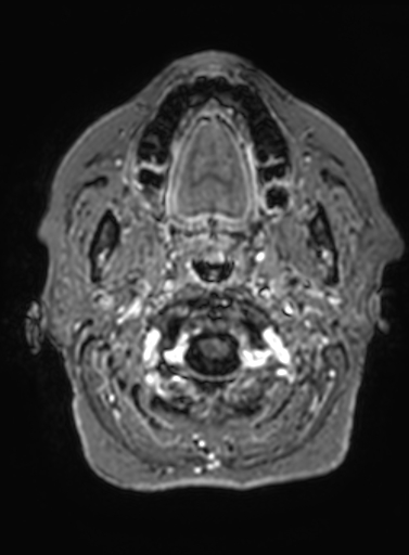 Cavernous hemangioma of the cerebellar falx (Radiopaedia 73025-83724 Axial T1 C+ 336).jpg