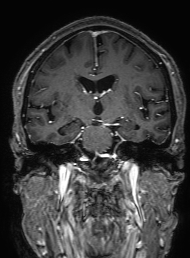 Cavernous hemangioma of the cerebellar falx (Radiopaedia 73025-83724 Coronal T1 C+ 191).jpg