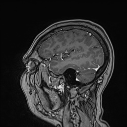 Cavernous sinus meningioma (Radiopaedia 63682-72367 Sagittal T1 C+ 132).jpg