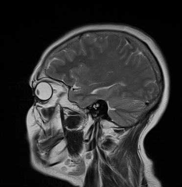 File:Cavernous sinus meningioma (Radiopaedia 63682-72367 Sagittal T2 15).jpg