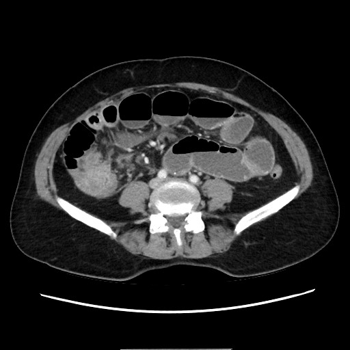 Cecal adenocarcinoma (Radiopaedia 75909-87331 A 56).jpg