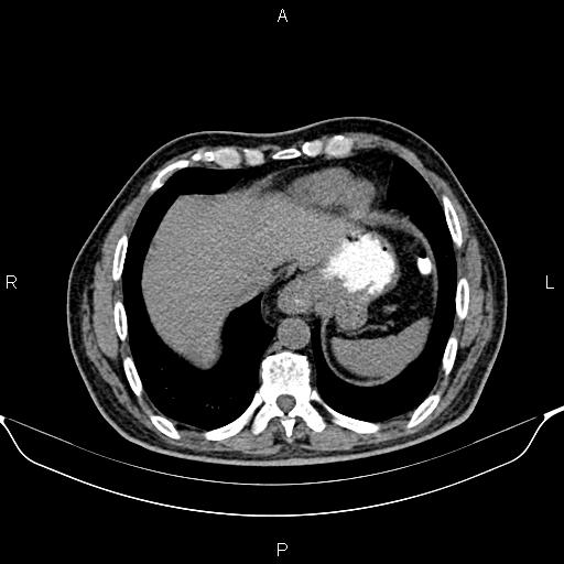 Cecal adenocarcinoma (Radiopaedia 85324-100916 Axial non-contrast 10).jpg