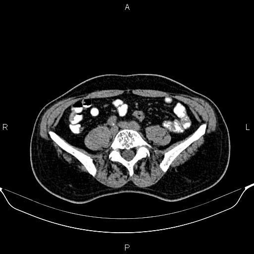 Cecal adenocarcinoma (Radiopaedia 85324-100916 Axial non-contrast 64).jpg