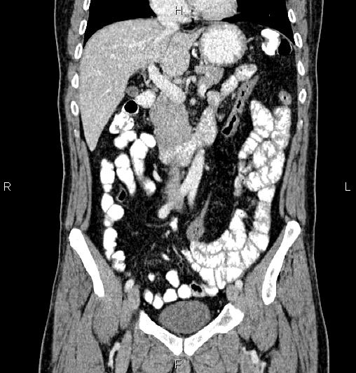 Cecal adenocarcinoma (Radiopaedia 85324-100916 D 26).jpg