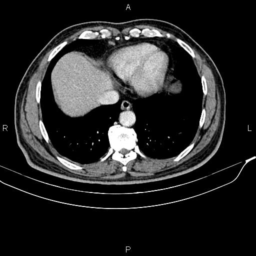 File:Cecal cancer with appendiceal mucocele (Radiopaedia 91080-108651 B 14).jpg