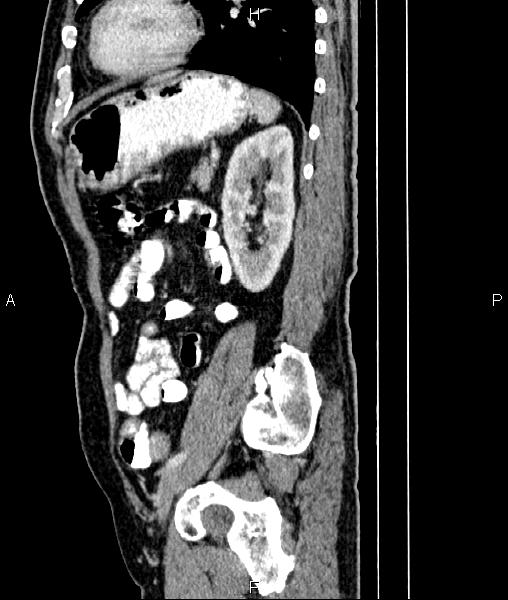 File:Cecal cancer with appendiceal mucocele (Radiopaedia 91080-108651 E 69).jpg