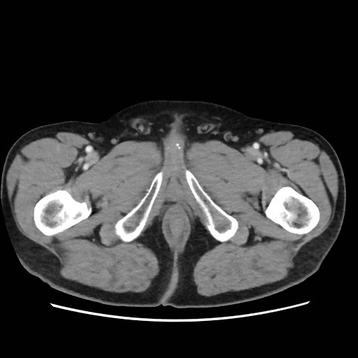 Cecal mass causing appendicitis (Radiopaedia 59207-66531 A 95).jpg
