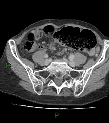 Cecal volvulus (Radiopaedia 86741-102900 A 93).jpg
