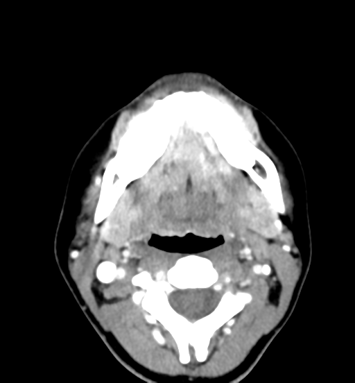 Cemento-ossifying fibroma (Radiopaedia 46243-50643 Axial C+ delayed 41).png