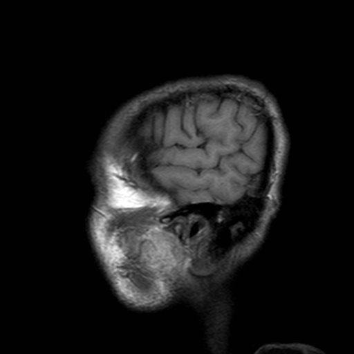 File:Central-variant posterior reversible encephalopathy syndrome (PRES) (Radiopaedia 43880-47358 Sagittal T1 23).jpg