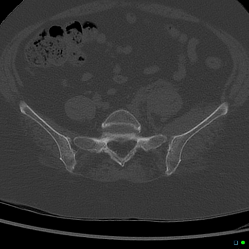 File:Central fracture-dislocation of the acetabulum (Radiopaedia 36578-38150 Axial bone window 6).jpg