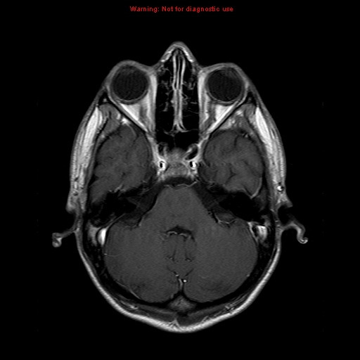 File:Central nervous system vasculitis (Radiopaedia 8410-9235 Axial T1 C+ 6).jpg