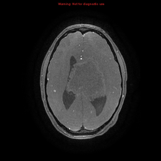 Central neurocytoma (Radiopaedia 13188-13206 Axial MRA 14).jpg