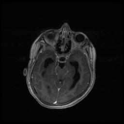Central neurocytoma (Radiopaedia 30220-30842 Axial T1 C+ 55).jpg
