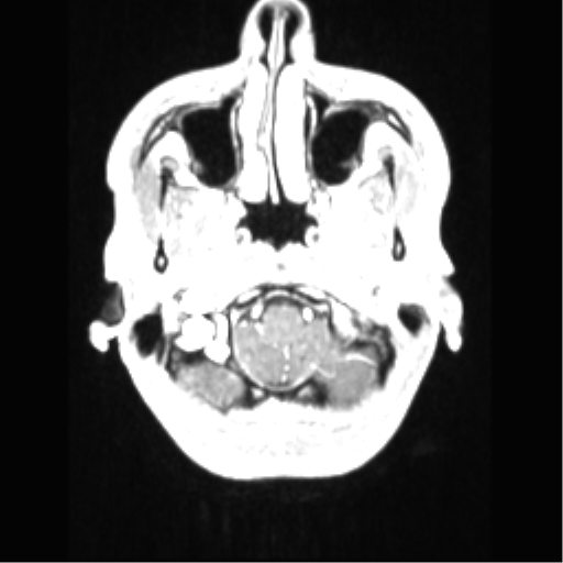 File:Central neurocytoma (Radiopaedia 37664-39557 Axial T1 C+ 11).png