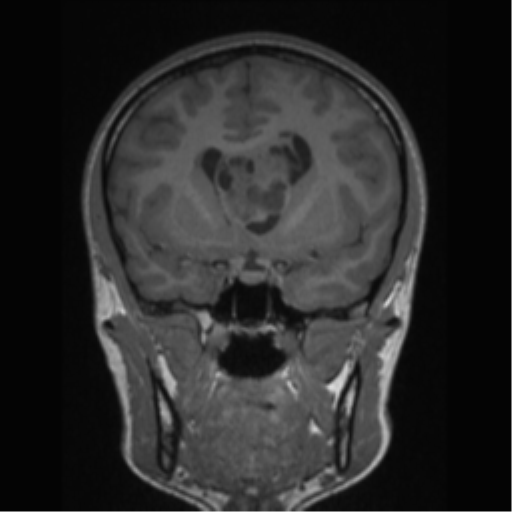 Central neurocytoma (Radiopaedia 37664-39557 Coronal T1 56).png