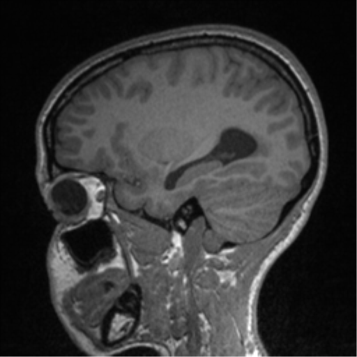 Central neurocytoma (Radiopaedia 37664-39557 Sagittal T1 68).png