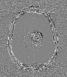 Central neurocytoma (Radiopaedia 84497-99872 Axial 43).jpg