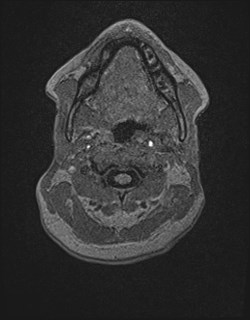 File:Central neurocytoma (Radiopaedia 84497-99872 Axial T1 6).jpg