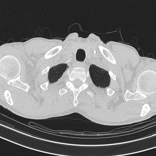 Central venous catheter tip extravasation (Radiopaedia 82828-97113 Axial lung window 11).jpg
