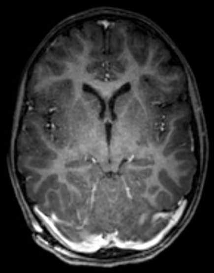 Cerebellar abscess (Radiopaedia 73727-84563 Axial T1 C+ fat sat 60).jpg