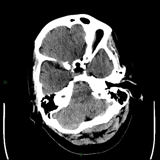 Cerebellar abscess (Radiopaedia 78135-90671 Axial non-contrast 26).jpg