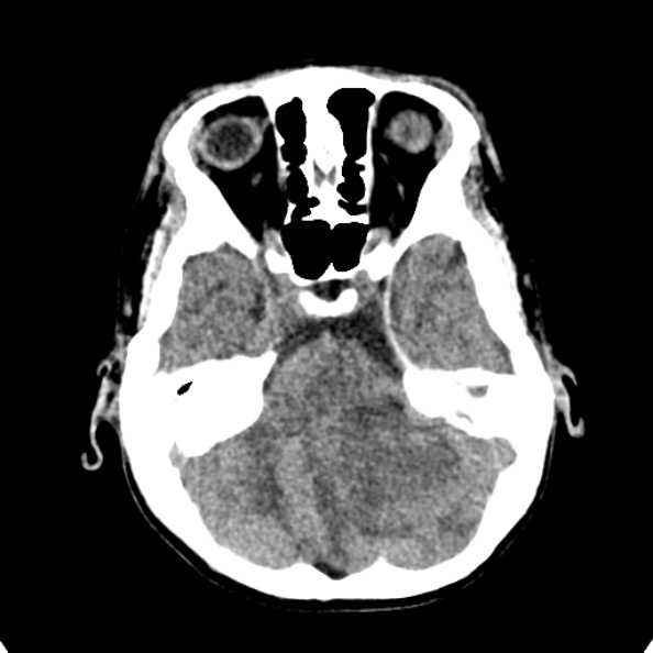 Cerebellar abscess secondary to mastoiditis (Radiopaedia 26284-26412 Axial non-contrast 40).jpg