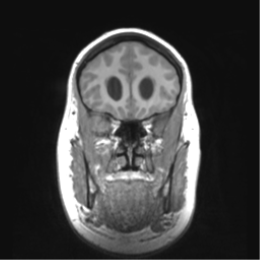 Cerebellar ependymoma complicated by post-operative subdural hematoma (Radiopaedia 83322-97736 Coronal T1 16).png