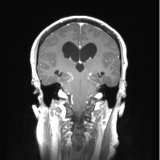 Cerebellar ependymoma complicated by post-operative subdural hematoma (Radiopaedia 83322-97736 Coronal T1 C+ 32).png