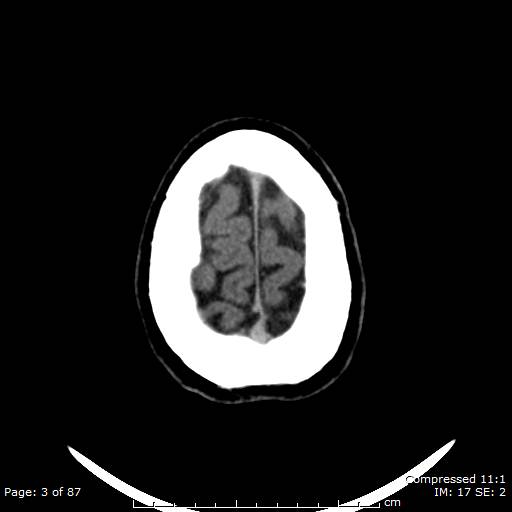 Cerebellar hemangioblastoma (Radiopaedia 52360-58258 Axial non-contrast 3).jpg