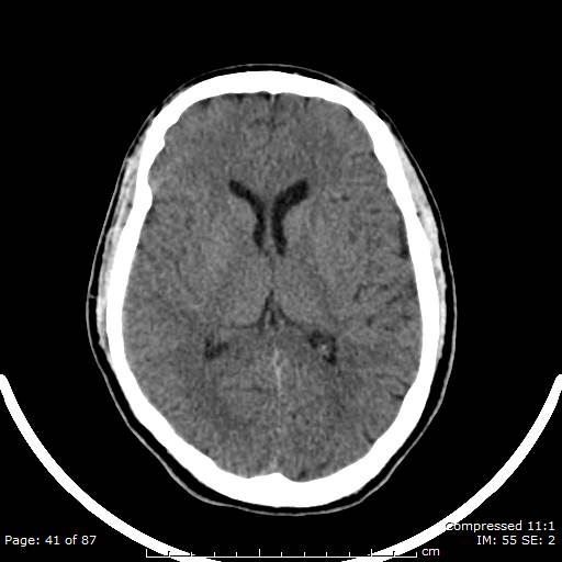 Cerebellar hemangioblastoma (Radiopaedia 52360-58258 Axial non-contrast 41).jpg