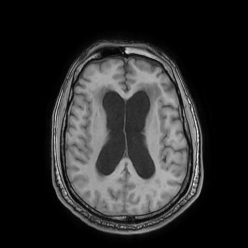 File:Cerebellar hemangioblastoma (Radiopaedia 88055-104622 Axial T1 22).jpg