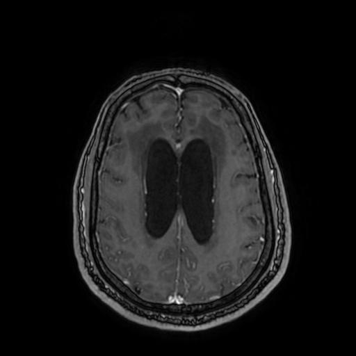 Cerebellar hemangioblastoma (Radiopaedia 88055-104622 Axial T1 C+ 123).jpg
